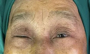 Làm gì khi sụp mi mắt?